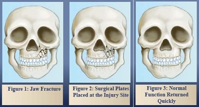 Medical diagram showing three stages of jaw fracture treatment with surgical plates